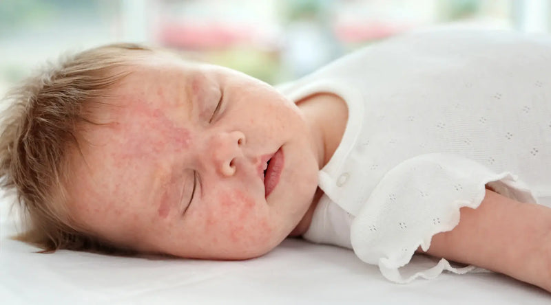 Eczema